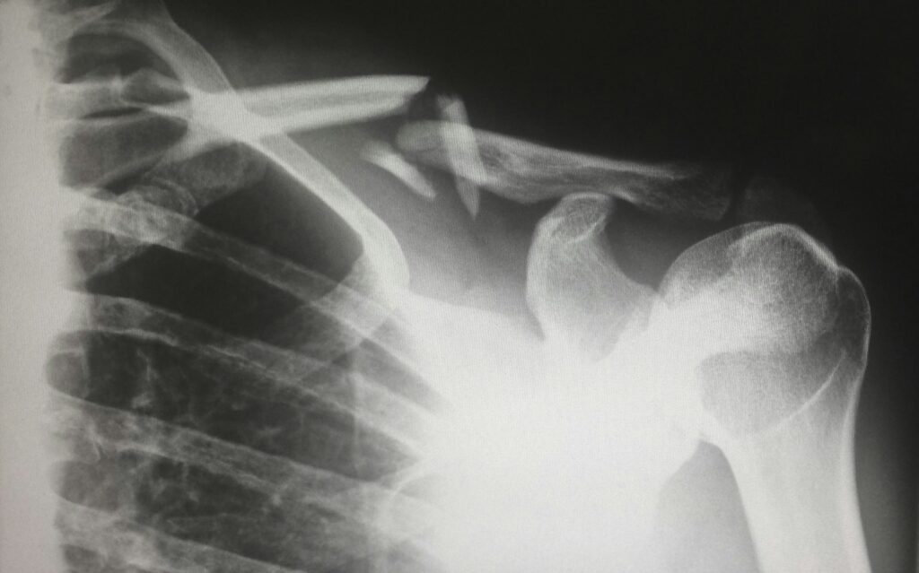 A black and white photo of an x-ray.